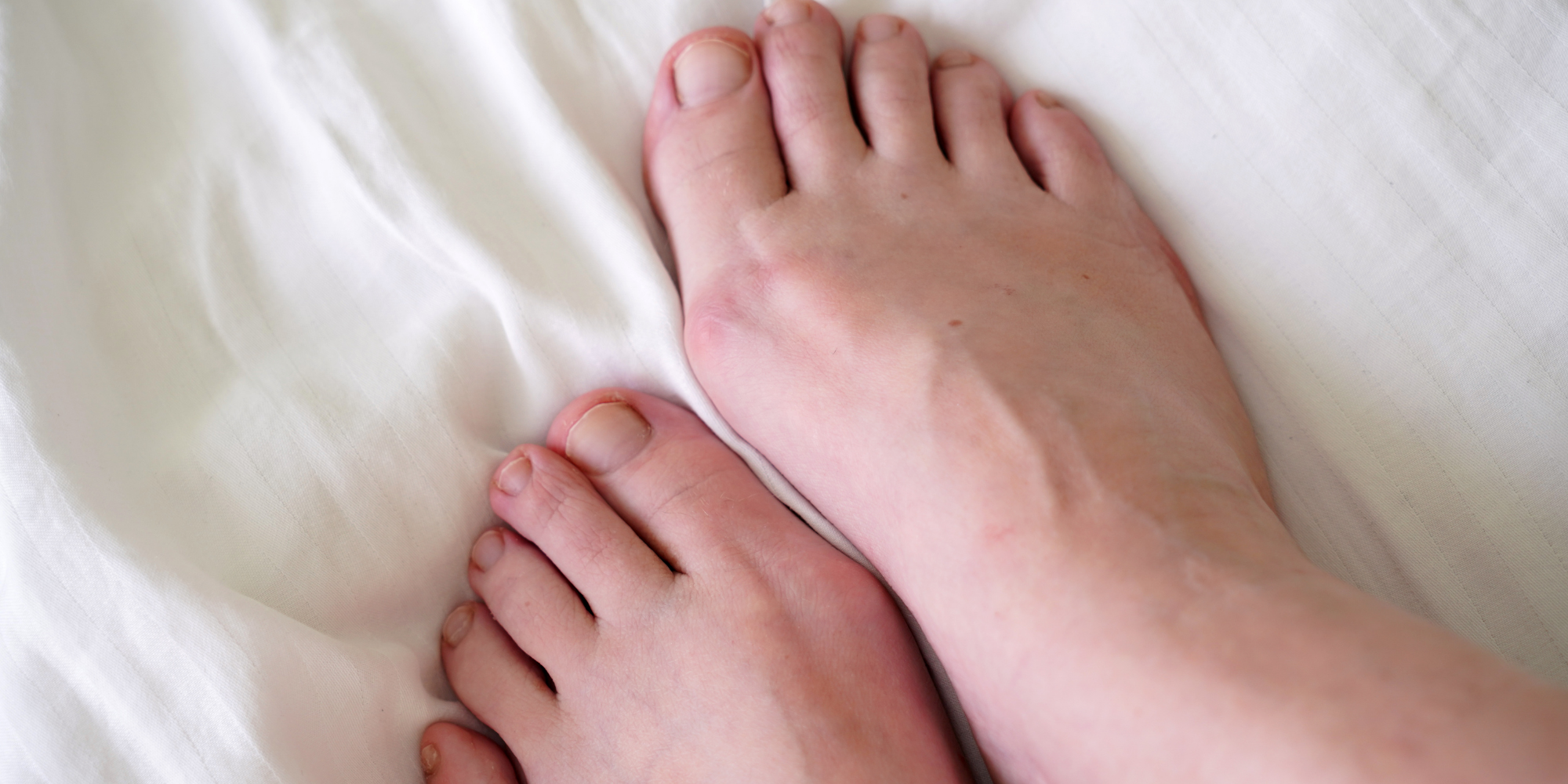 Baş Parmak Çıkıntısı (Halluks Valgus) Tedavisi