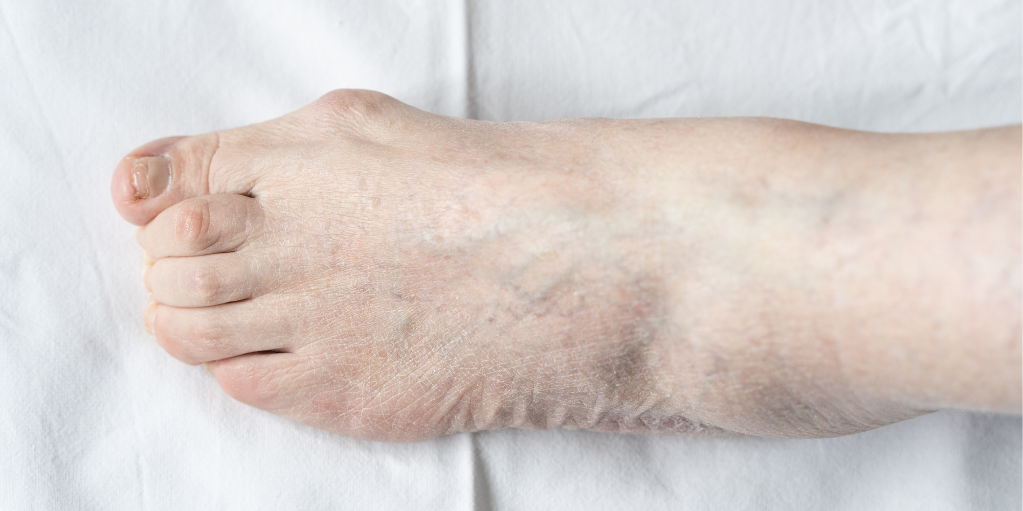 Baş Parmak Çıkıntısı (Halluks Valgus) Nasıl Görünür?