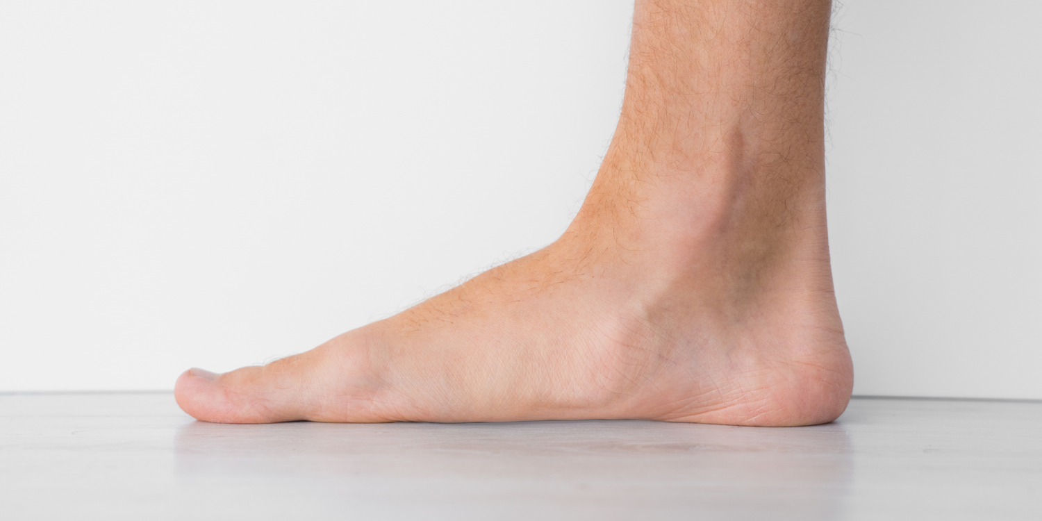 Düz Tabanlık Topuk Dikenini Nasıl Etkiler?