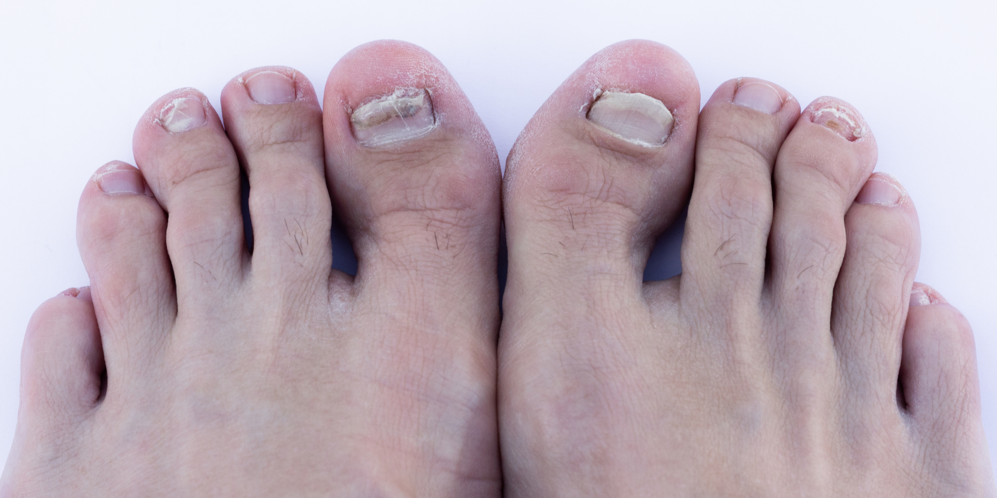 Baş Parmak Çıkıntısı (Halluks Valgus) Nerede ve Nasıl Oluşur?