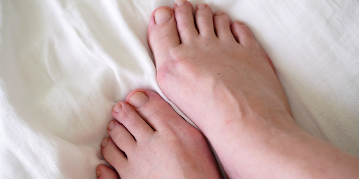 Baş Parmak Çıkıntısı (Halluks Valgus) Tedavisi