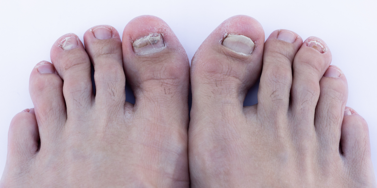  Baş Parmak Çıkıntısı (Halluks Valgus) Nerede ve Nasıl Oluşur?