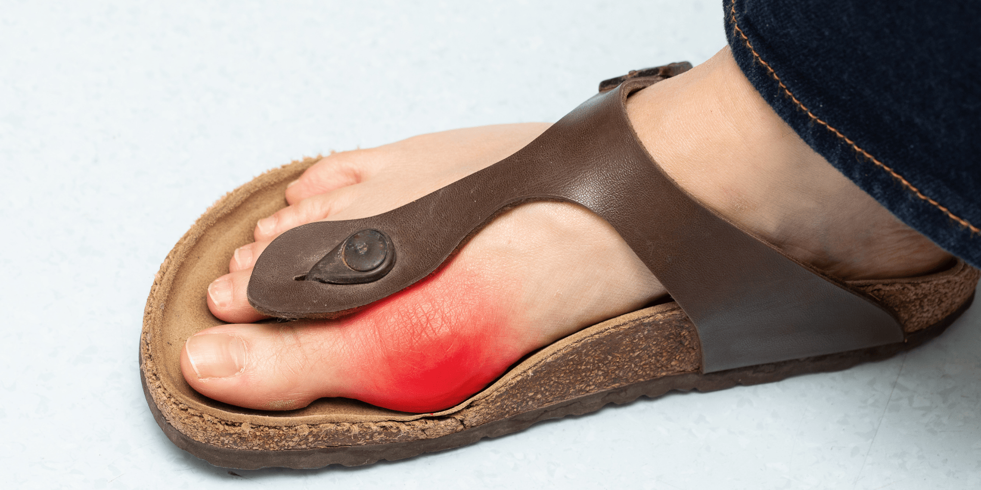 Baş Parmak Çıkıntısı (Halluks Valgus) Ne İyi Gelir?