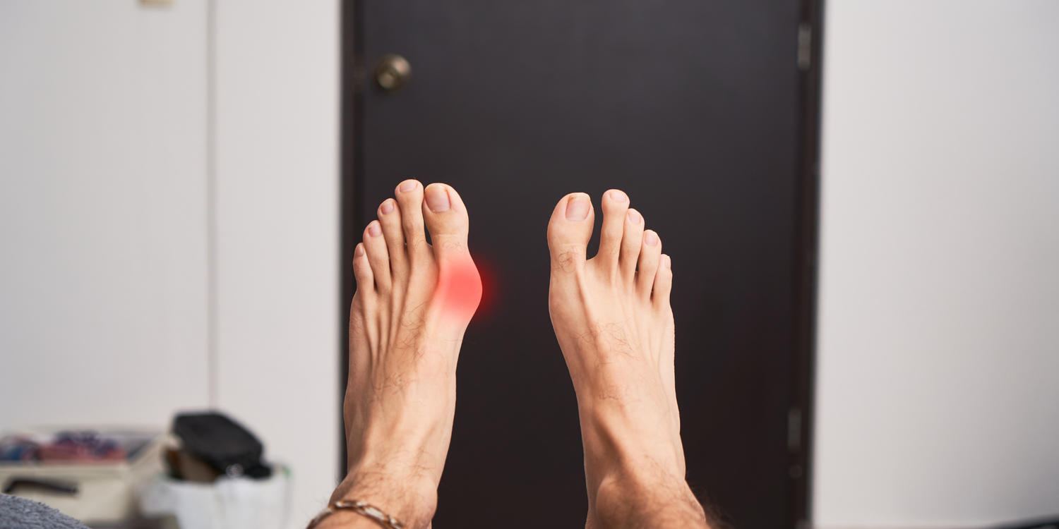  Halluks Valgus Tam Olarak Nedir? 