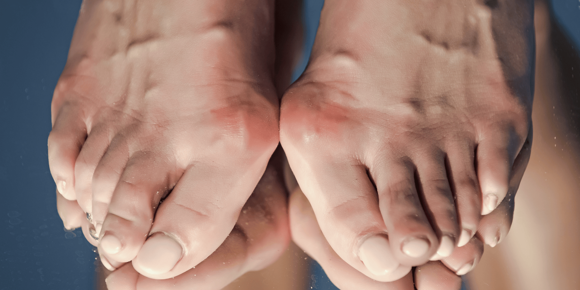 Baş Parmak Çıkıntısı (Halluks Valgus) Belirtileri ve Nedenleri